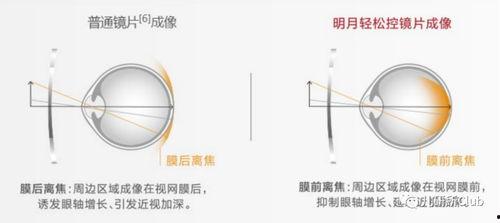 国产离焦镜片对比视频,创新科技，视界新体验